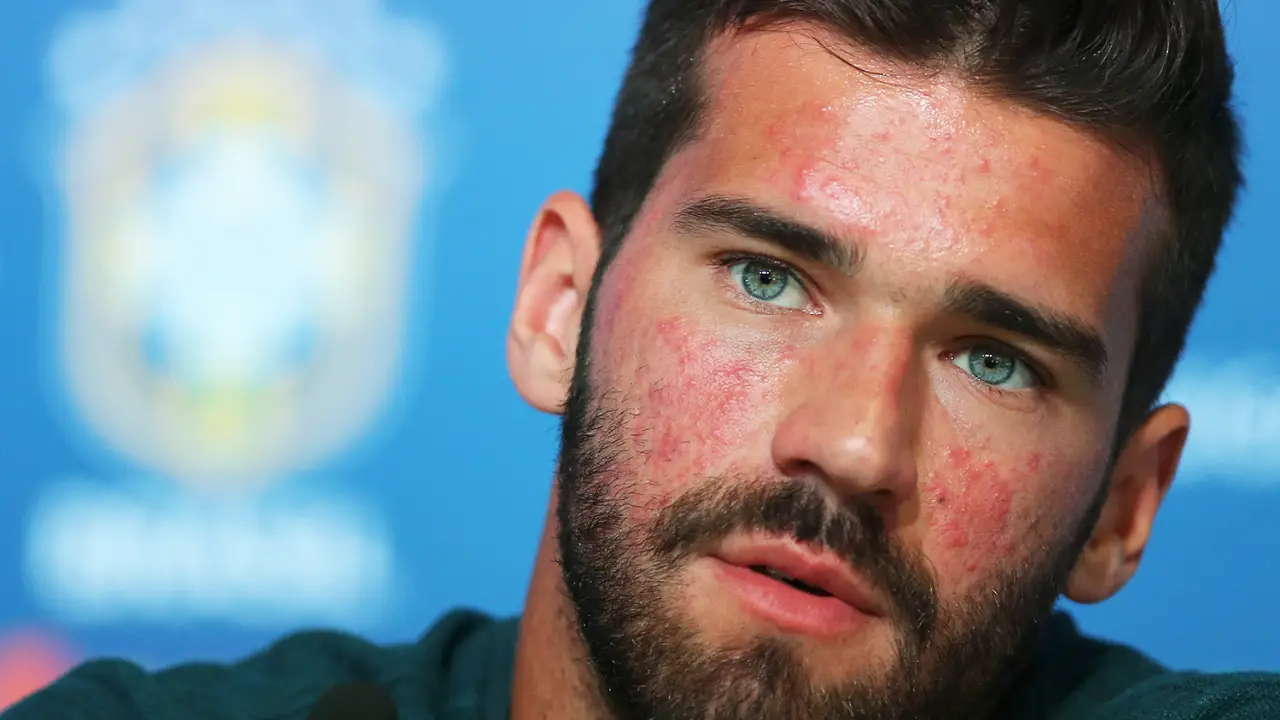 imagem rosacea
